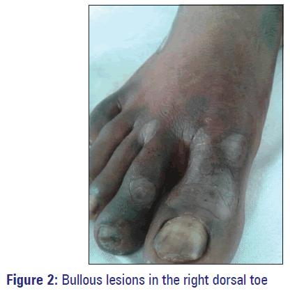 Basic-Clinical-Pharmacy-Bullous-lesions-dorsal