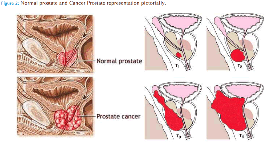 Basic-Clinical-Pharmacy-Normal-prostate-Cancer