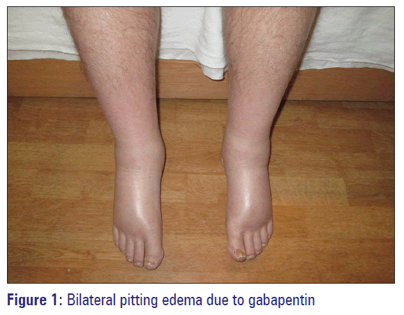 Basic-clinical-pharmacy-Bilateral-pitting-edema-gabapentin