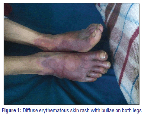 Basic-clinical-pharmacy-Diffuse-erythematous-skin-rash