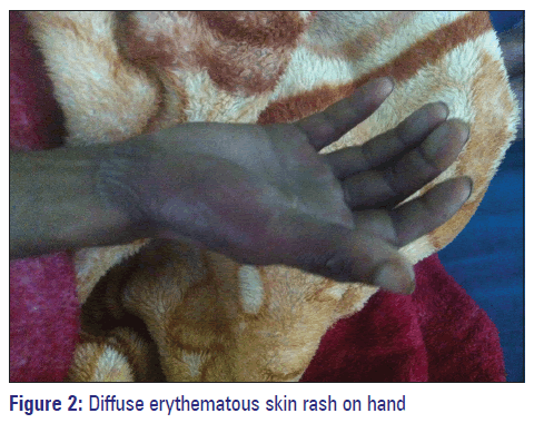 Basic-clinical-pharmacy-Diffuse-erythematous-skin-rash-hand