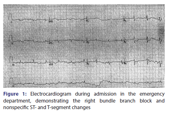 Basic-clinical-pharmacy-Electrocardiogram-during