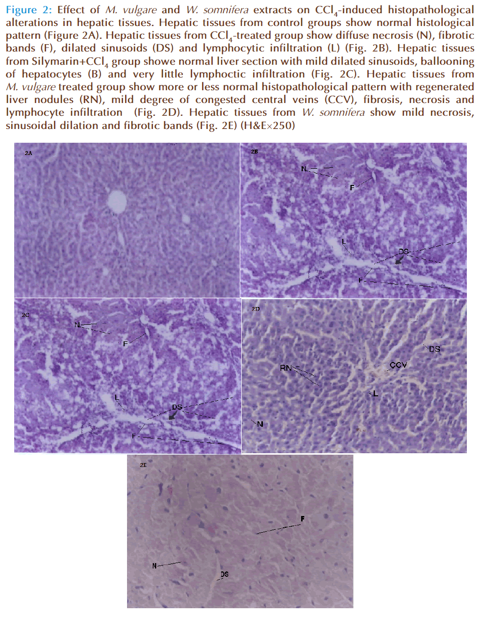 Basic-clinical-pharmacy-ballooning-hepatocytes