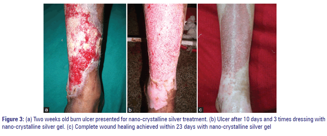 Basic-clinical-pharmacy-weeks-old-burn-ulcer